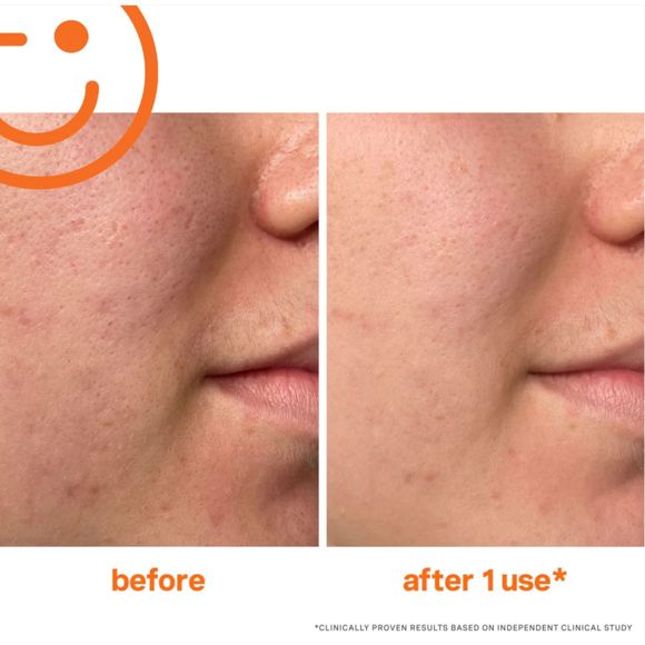 NIB LIMITED ED Kate Somerville EXFOLIKATE Intensive Exfoliating Treatment AHA - Picture 4 of 13